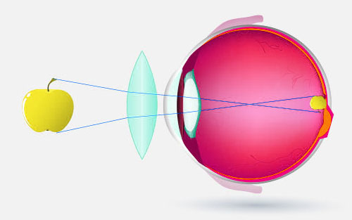L’astigmatismo viene normalmente corretto con lenti toriche
